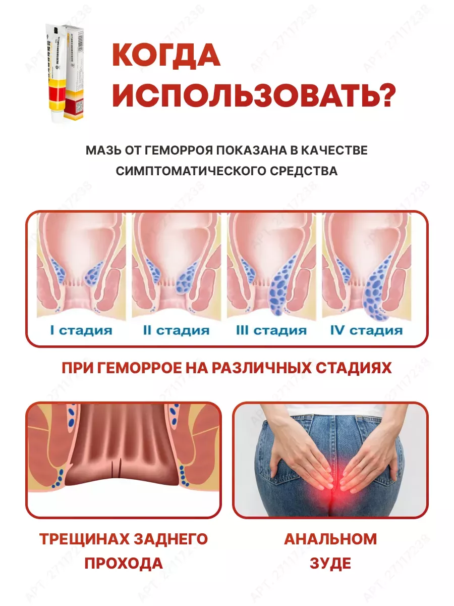 Стадии геморроя - симптомы, признаки и лечение 1, 2, 3 и 4 стадии