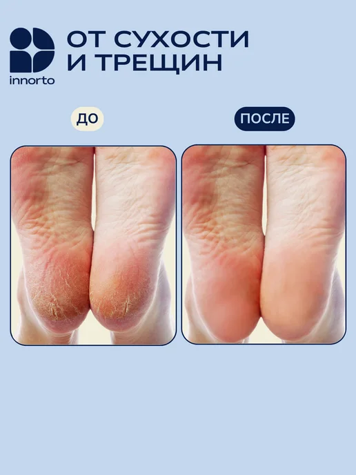INNORTO Силиконовые напяточники от трещин, 1 пара, вариант, фото 3