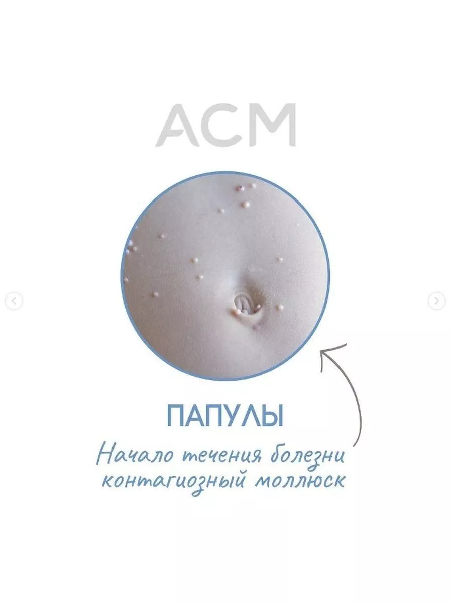 МОЛЮТРЕКС лосьон против кожного контагиозного моллюска. 3 мл ACM  laboratoire dermatologique 200987840 купить в интернет-магазине Wildberries